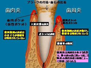 歯周病のしくみの図解