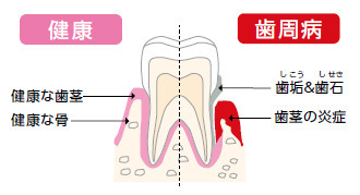 本当は怖い歯周病（ししゅうびょう）のイメージ