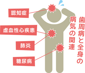 歯周病と全身の病気（認知症・虚血性心疾患・肺炎・糖尿病）の関連のイラスト