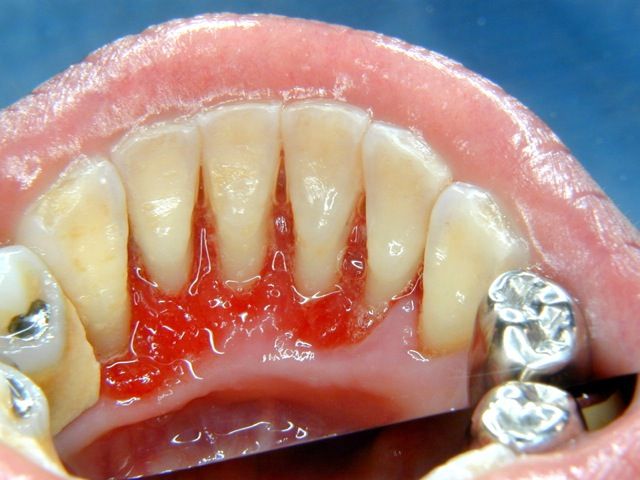 歯石をとった直後の状態（写真）