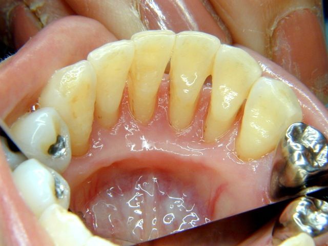 歯みがき指導後改善した歯肉の様子（写真）