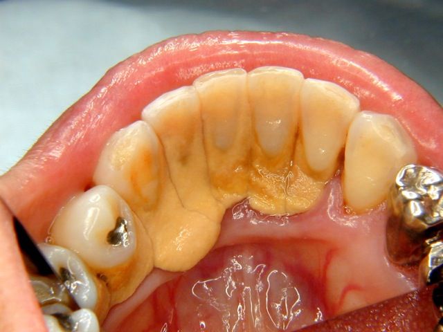 歯石がついた歯の写真