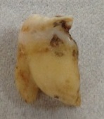 歯肉の下の歯石をとった後の写真