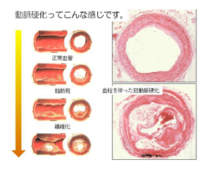 動脈硬化画像